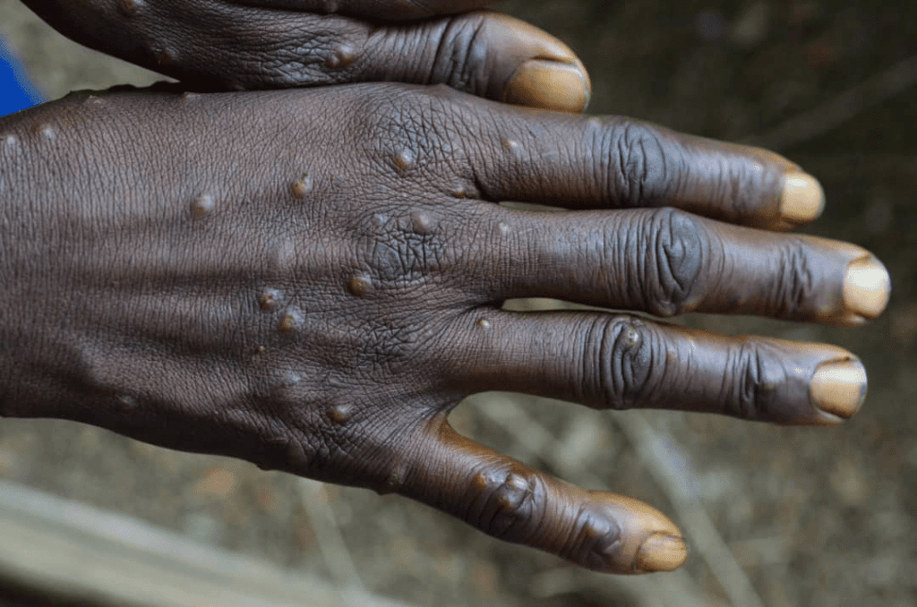 Close-up of hands showing Mpox lesions.  Key phrases: Mpox cases, protecting vulnerable, health and hygiene, self-care solutions, vaccination efforts. Crypto donations via BTC support aid.
