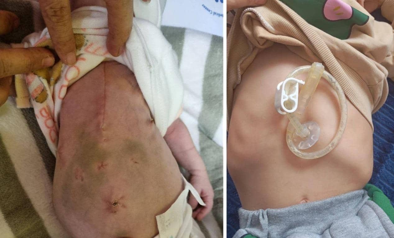 Before and after surgical scars on a baby's abdomen, showing healing and recovery for children's healthcare supported by crypto donations to Islamic Donate Charity, like ETH.