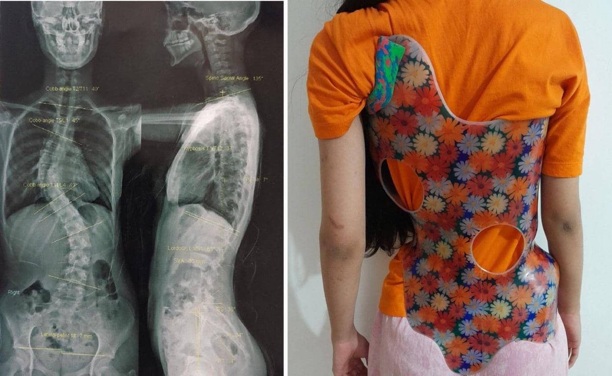 X-ray showing spinal scoliosis and a child wearing a custom-fitted back brace for posture correction, supported by SOL donations. Helping children in need.