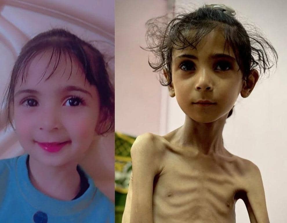 Split image showing a child's face on the left and a severely emaciated child on the right, embodying the stark contrast of need for orphan care; sponsorship with BTC provides food, shelter, and education for vulnerable children.