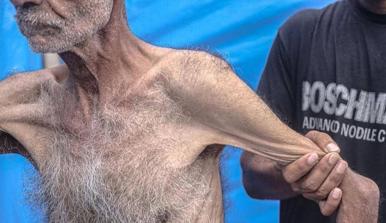An emaciated man's arm is pulled by another person's hand, illustrating the urgent need for Iftar in war zones made possible by crypto donations like SOL.