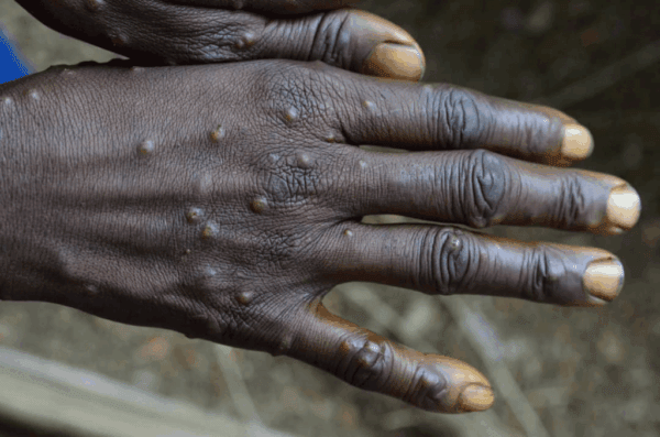 Close-up of hands showing Mpox lesions.  Key phrases: Mpox cases, protecting vulnerable, health and hygiene, self-care solutions, vaccination efforts. Crypto donations via BTC support aid.