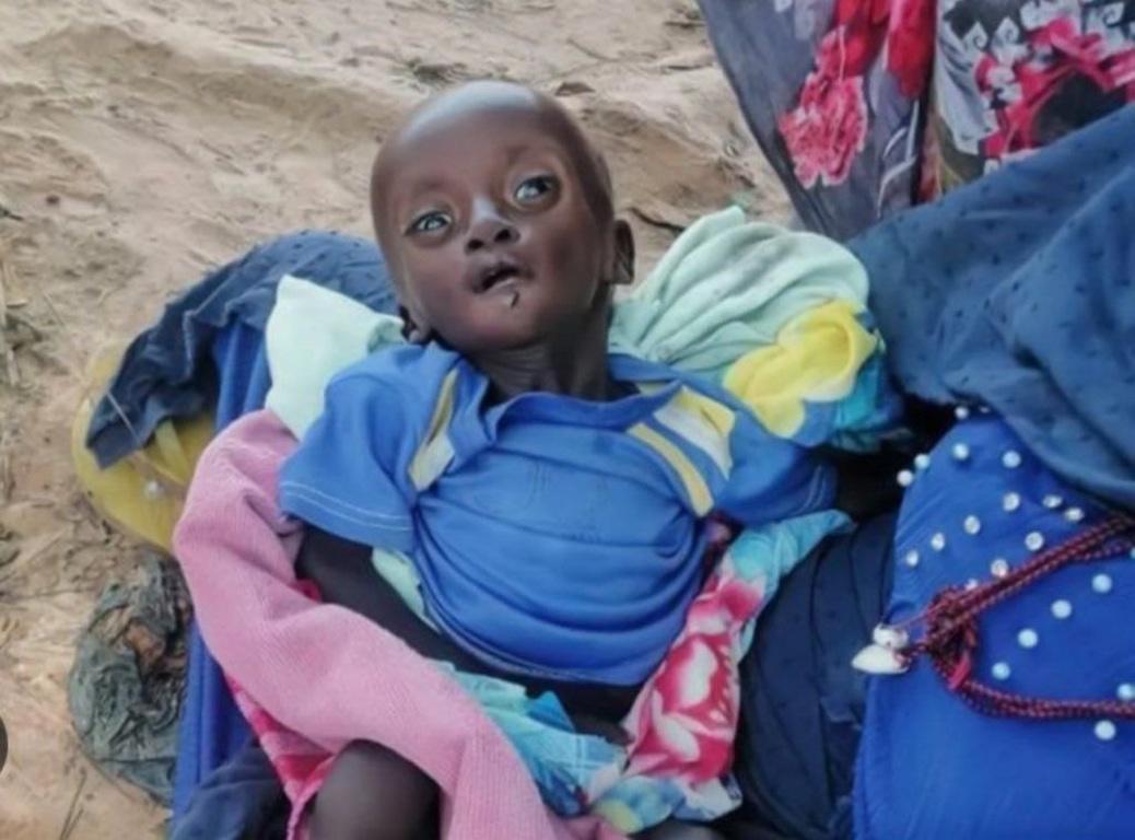 Ethiopia humanitarian crisis relief for child with severe acute malnutrition using LTC crypto donations for aid.