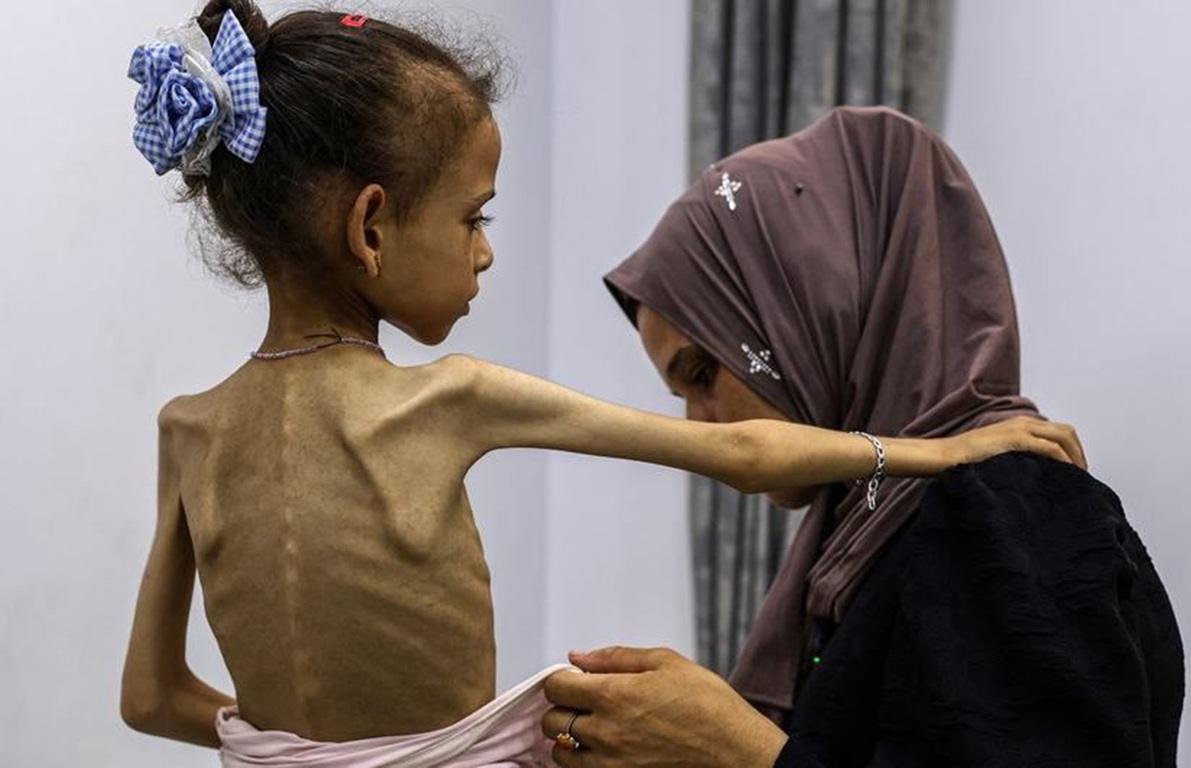 Gaza Crisis, supports malnourished children with urgent medical and food relief funded by RLUSD donations.