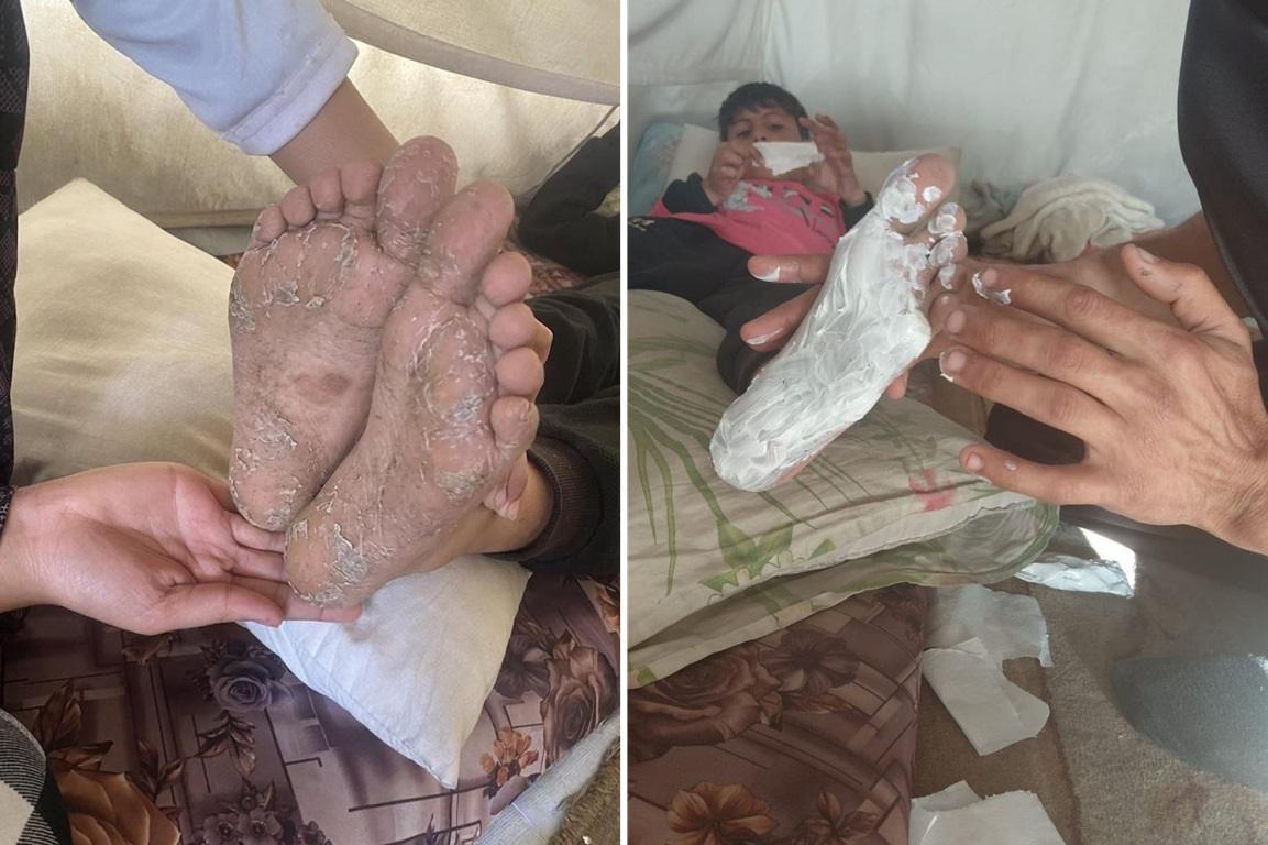 Child with impetigo using USDT crypto donations for medicine and Treating skin hazard.