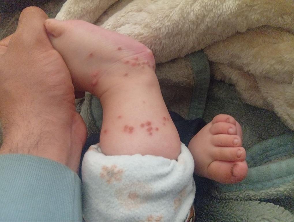 Child with bacterial infection on feet being held. RLUSD donations treat Gazan children with skin diseases in summer heat.