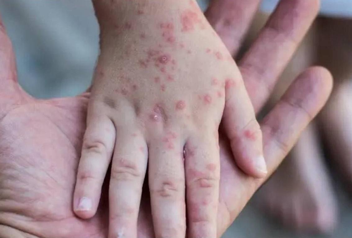 Gazans in the heat suffer skin infections impetigo. Use LTC to fund hygiene kits and medicine through Islamic Donate.