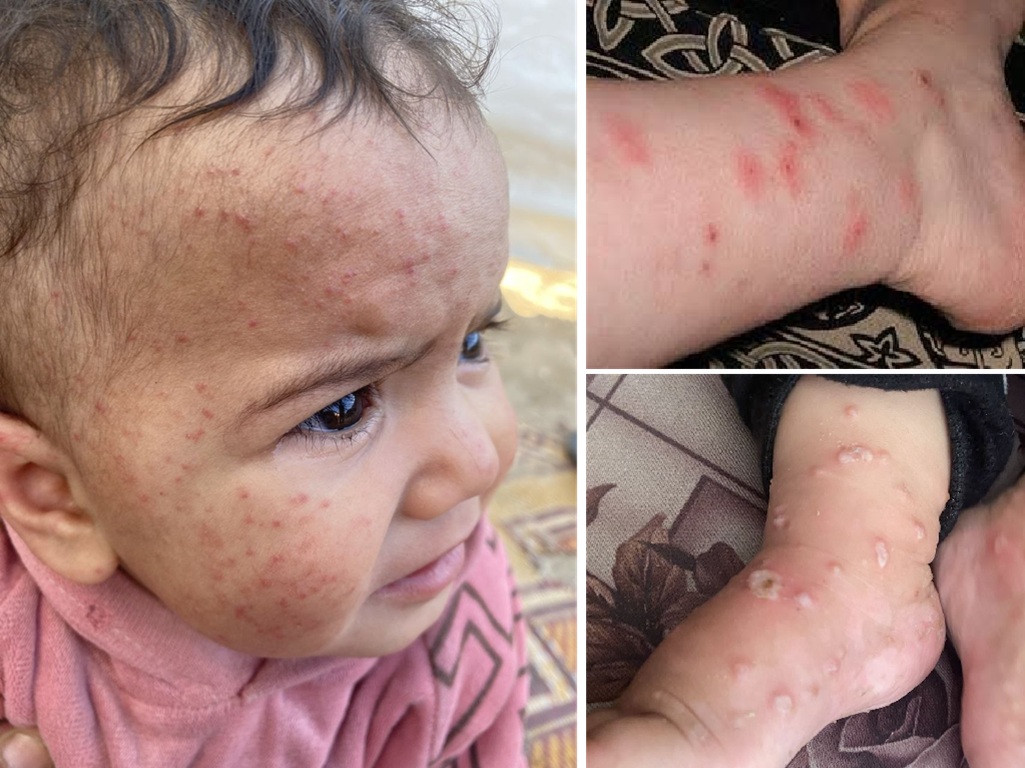 Gazan children with dangerous skin infections, scabies and impetigo. Donate USDT to treat Gaza heat disease hazards.