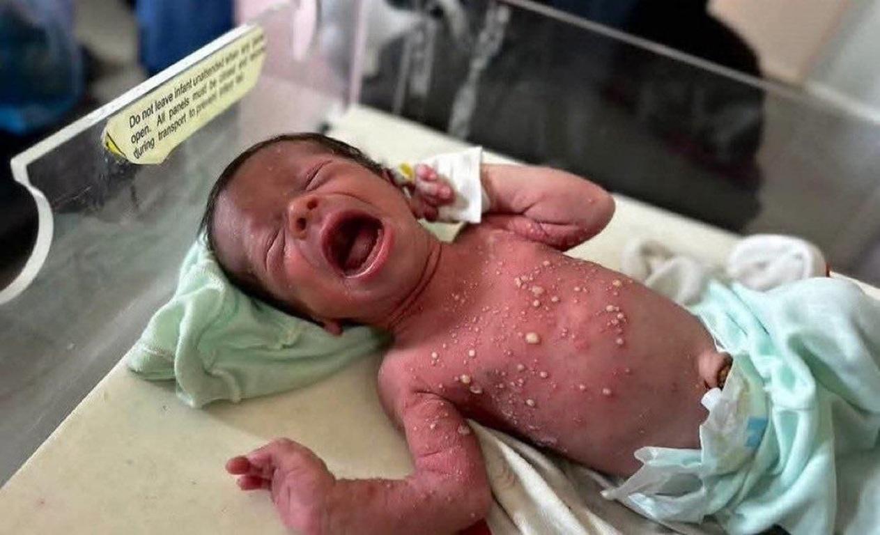 Gazan infant with painful skin disease sores cries in heat. Donate ETH to Islamic Donate Charity for life-saving medicine.