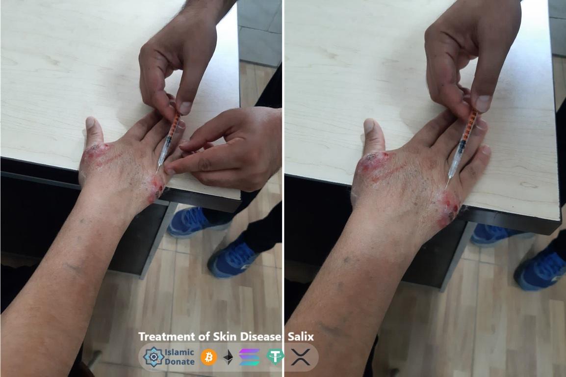 Doctor treating infected hand lesions with syringe to combat Gaza summer diseases via Ripple donations for medical relief.